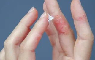 Applying CBD eczema cream to a infected fingers.