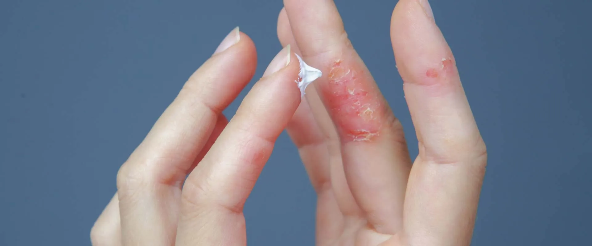 Applying CBD eczema cream to a infected fingers.