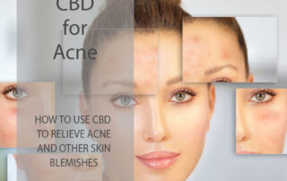 CBD for Acne - How CBD can help reduce acne