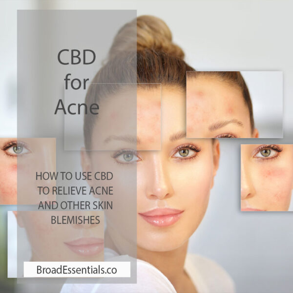 CBD for Acne – How CBD can help reduce acne CBD for Acne - How CBD can help reduce acne